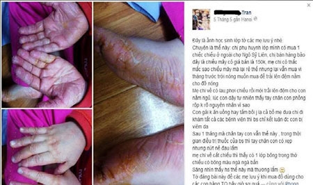 Hình ảnh Chiếu điều hòa giá rẻ gây viêm da, dị ứng da được chia sẻ trên Facebook